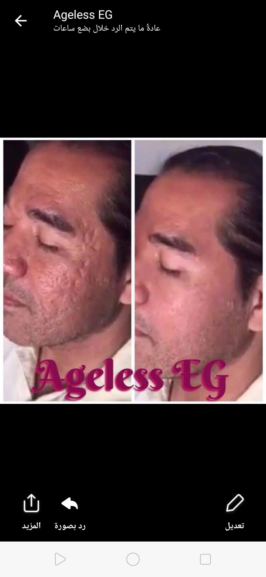 ageless cream
لا تنسَ أنك شاهدت هذا الإعلان في عنكبوت
الحل الامثل لمشكله التجاعيد و الانتفاخا...